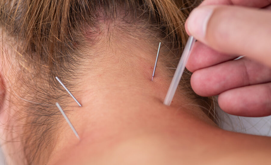 Dry Needling – What It Is, How It Works, and Who It Helps: If you've ever had a stubborn muscle knot that just won't quit, you know how frustrating it can be.